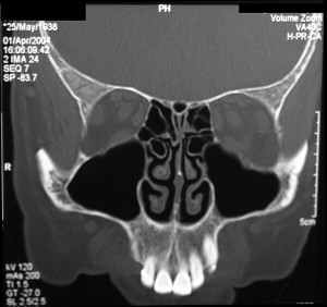 Normal sinus CT scan