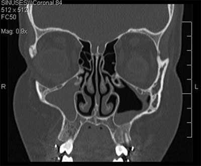 will steroids help a sinus infection