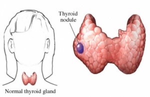 Thyroid-nodules