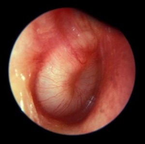 Infected fluid seen behind eardrum