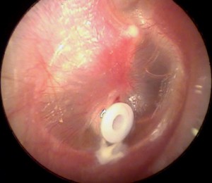 Eardrum with tube in place.