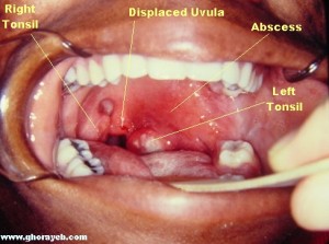 Left peritonsillar abscess