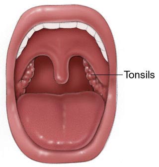 tonsils throat need tonsil surgery removed why mouth tonsillectomy stones chronic know where two