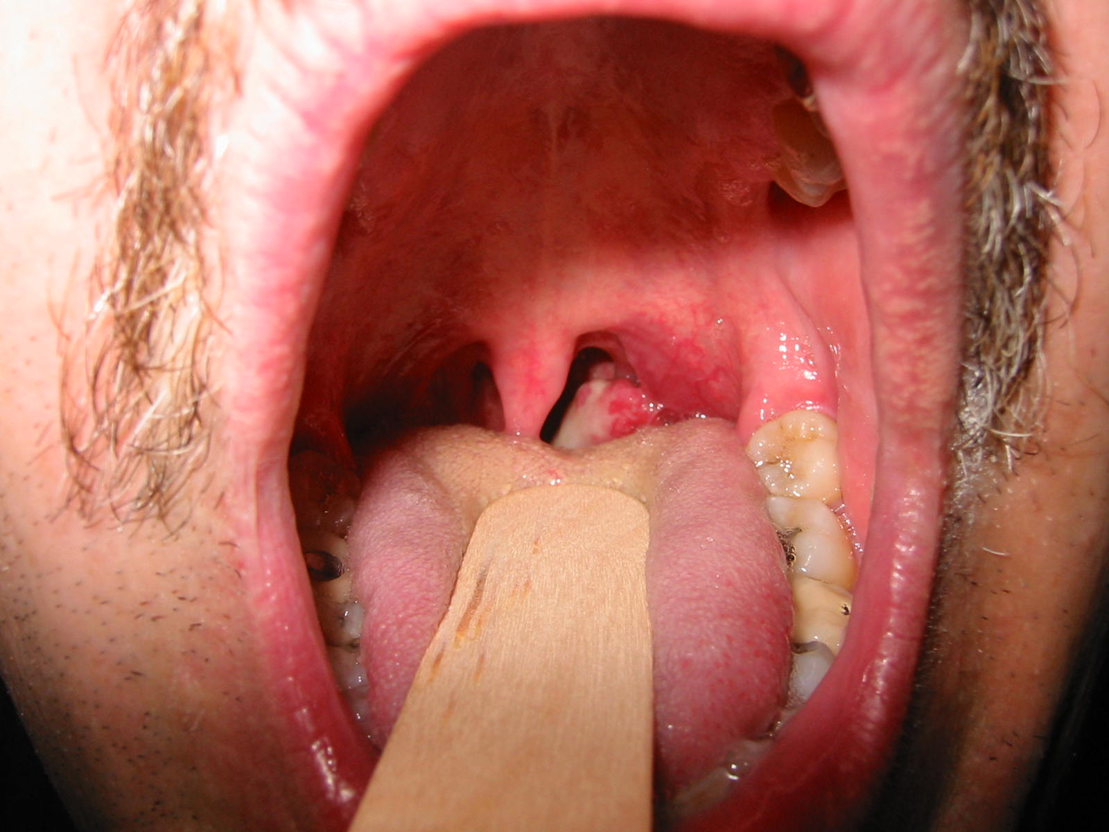 throat cancer symptoms 